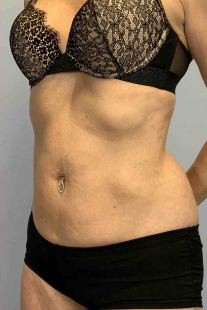 VASER Liposelection Before & After Patient #10407