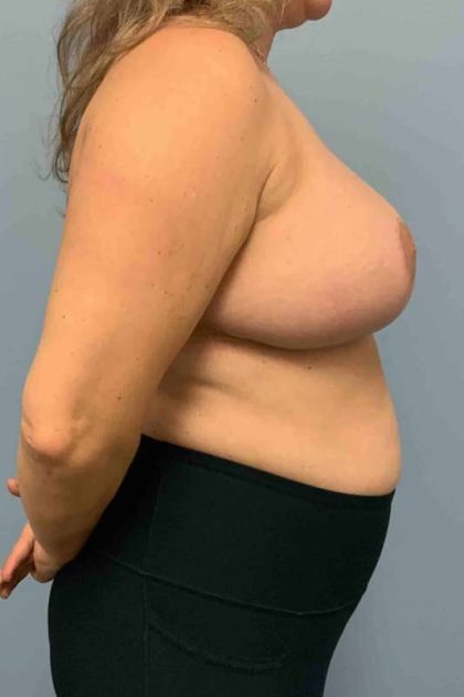 VASER Liposelection Before & After Patient #10552