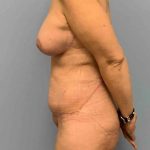 VASER Liposelection Before & After Patient #10561