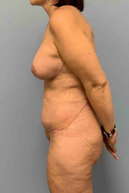 VASER Liposelection Before & After Patient #10561
