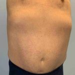 VASER Liposelection Before & After Patient #10575
