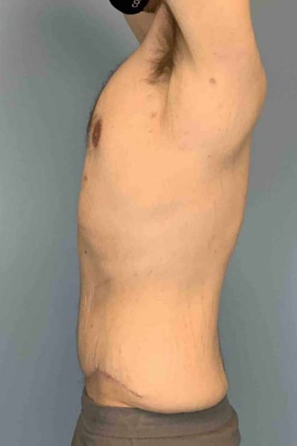 VASER Liposelection Before & After Patient #10602