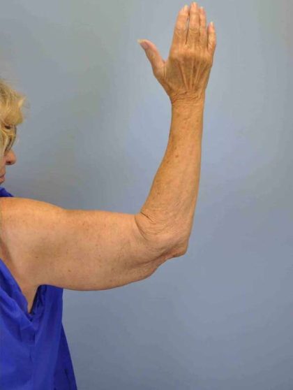 VASER Liposelection Before & After Patient #10615