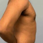 VASER Liposelection Before & After Patient #10622