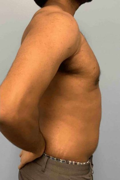 VASER Liposelection Before & After Patient #10622