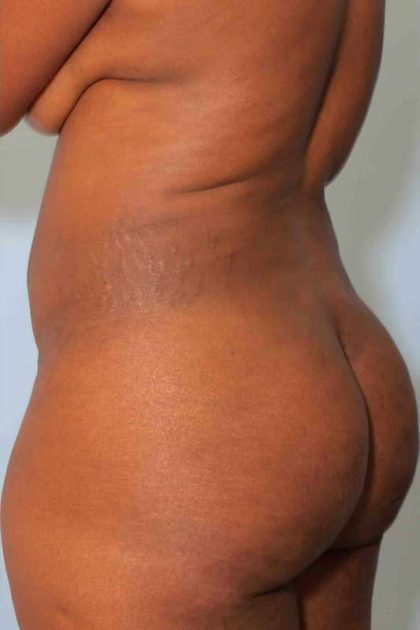 VASER Liposelection Before & After Patient #10631
