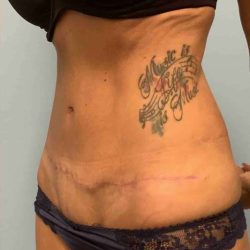VASER Liposelection Before & After Patient #10643
