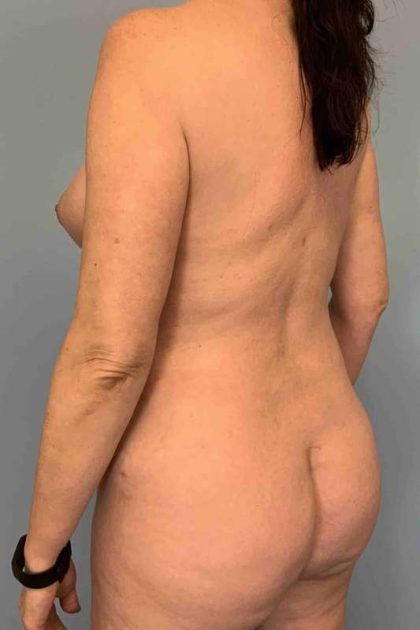 VASER Liposelection Before & After Patient #10670
