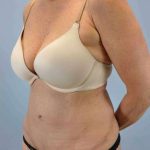 Tummy Tuck Before & After Patient #10675