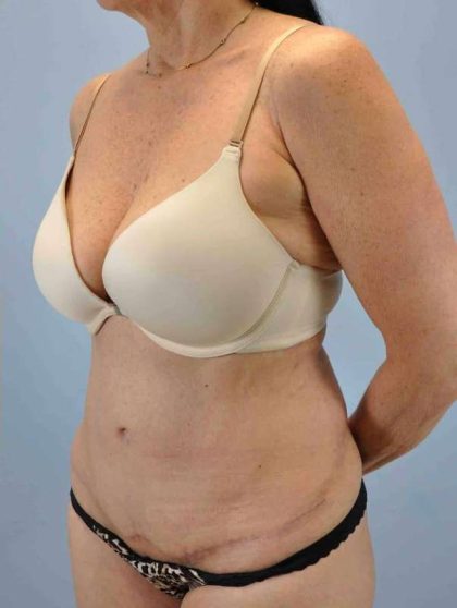 Tummy Tuck Before & After Patient #10675