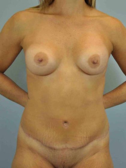 Tummy Tuck Before & After Patient #10682