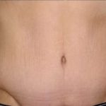 Tummy Tuck Before & After Patient #10689