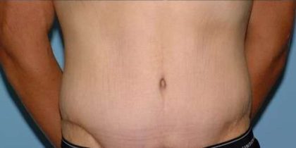 Tummy Tuck Before & After Patient #10689