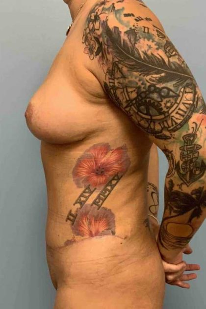 Tummy Tuck Before & After Patient #10816