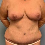 VASER Liposelection Before & After Patient #10391