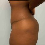 Tummy Tuck Before & After Patient #10839