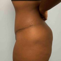 Tummy Tuck Before & After Patient #10839
