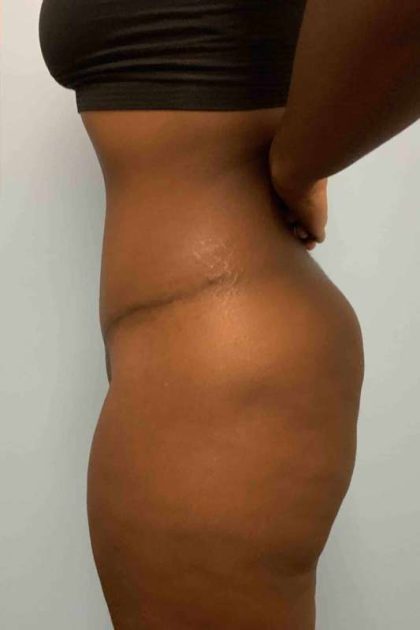 Tummy Tuck Before & After Patient #10839