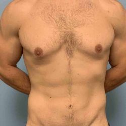 Tummy Tuck Before & After Patient #10846