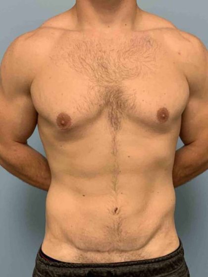 Tummy Tuck Before & After Patient #10846