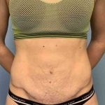 Tummy Tuck Before & After Patient #10862
