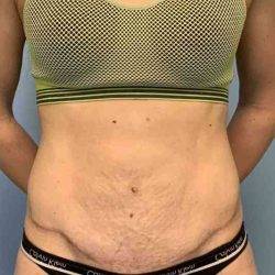 Tummy Tuck Before & After Patient #10862