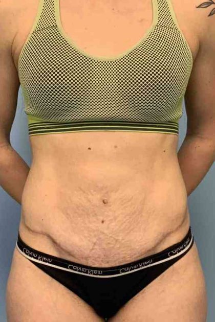 Tummy Tuck Before & After Patient #10862