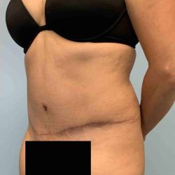 Tummy Tuck Before & After Patient #10869