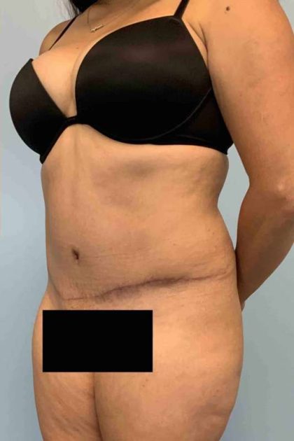 Tummy Tuck Before & After Patient #10869