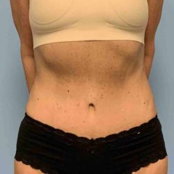 Tummy Tuck Before & After Patient #10881