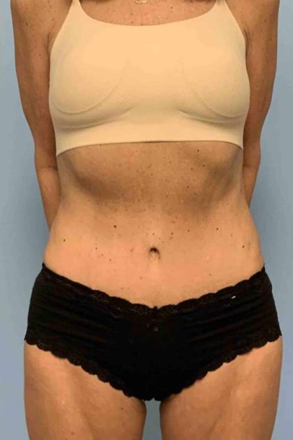 Tummy Tuck Before & After Patient #10881