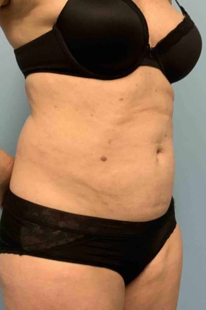 Renuvion Before & After Patient #10921