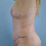 VASER Liposelection Before & After Patient #10384