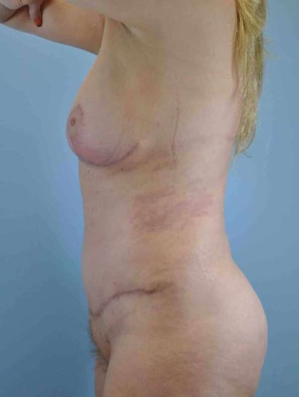 VASER Liposelection Before & After Patient #10384