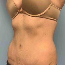 Renuvion Before & After Patient #10928