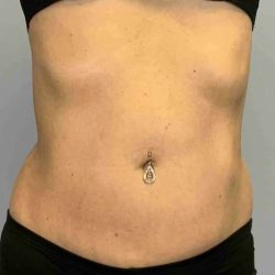 Renuvion Before & After Patient #10935