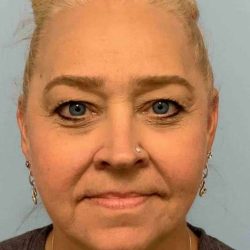 Renuvion Before & After Patient #10951