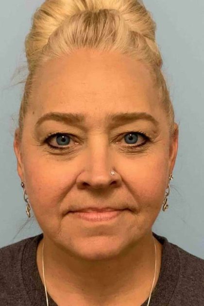 Renuvion Before & After Patient #10951