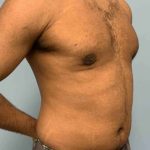 Renuvion Before & After Patient #10978