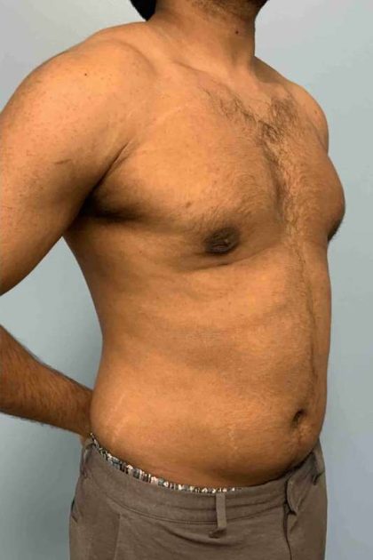 Renuvion Before & After Patient #10978