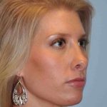 Nose Surgery Before & After Patient #10990