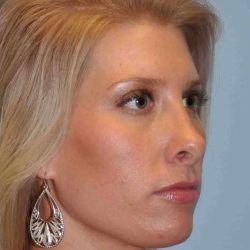 Nose Surgery Before & After Patient #10990