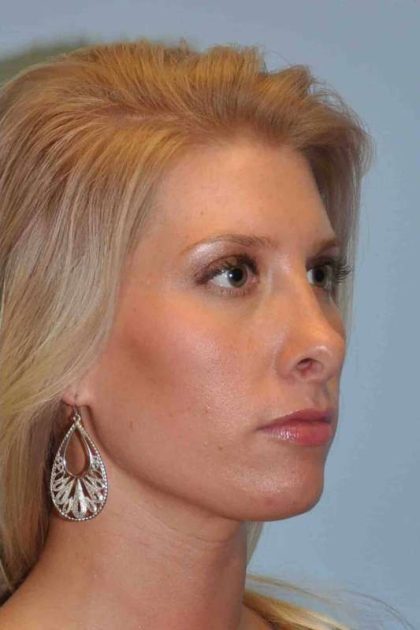 Nose Surgery Before & After Patient #10990