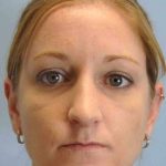 Nose Surgery Before & After Patient #10997