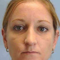 Nose Surgery Before & After Patient #10997