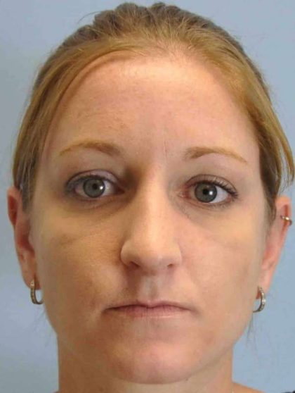 Nose Surgery Before & After Patient #10997