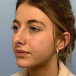 Nose Surgery Before & After Patient #11004