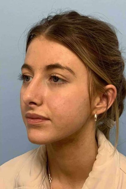 Nose Surgery Before & After Patient #11004