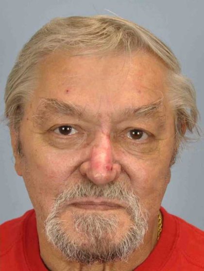 Nose Surgery Before & After Patient #11011