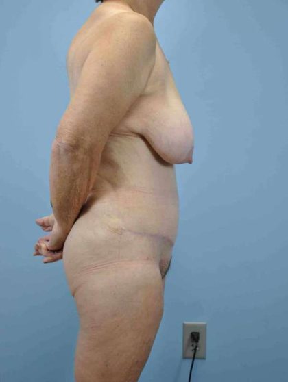 VASER Liposelection Before & After Patient #10377